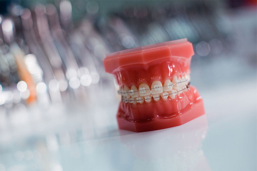 Ortodontski model gornje i donje čeljusti s postavljenim apartićima za zube