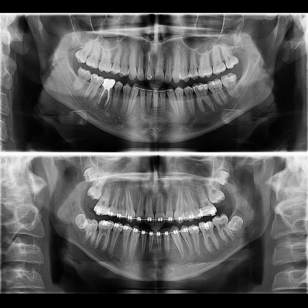 Dva dentalna ortopana, rendgenskih slika čeljusti sprijeda, jedan iznad drugog