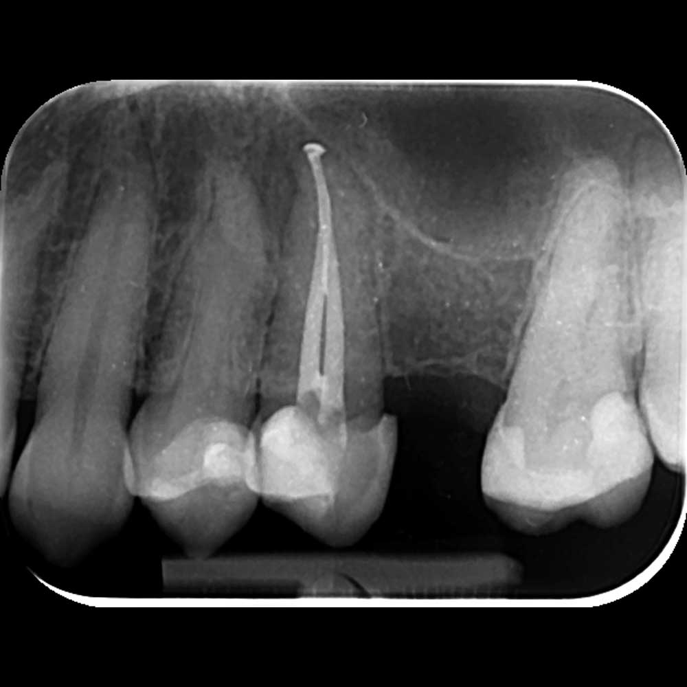 Intraoralna snimka zubi, mala rendgenska slika nekoliko zubi iz profila