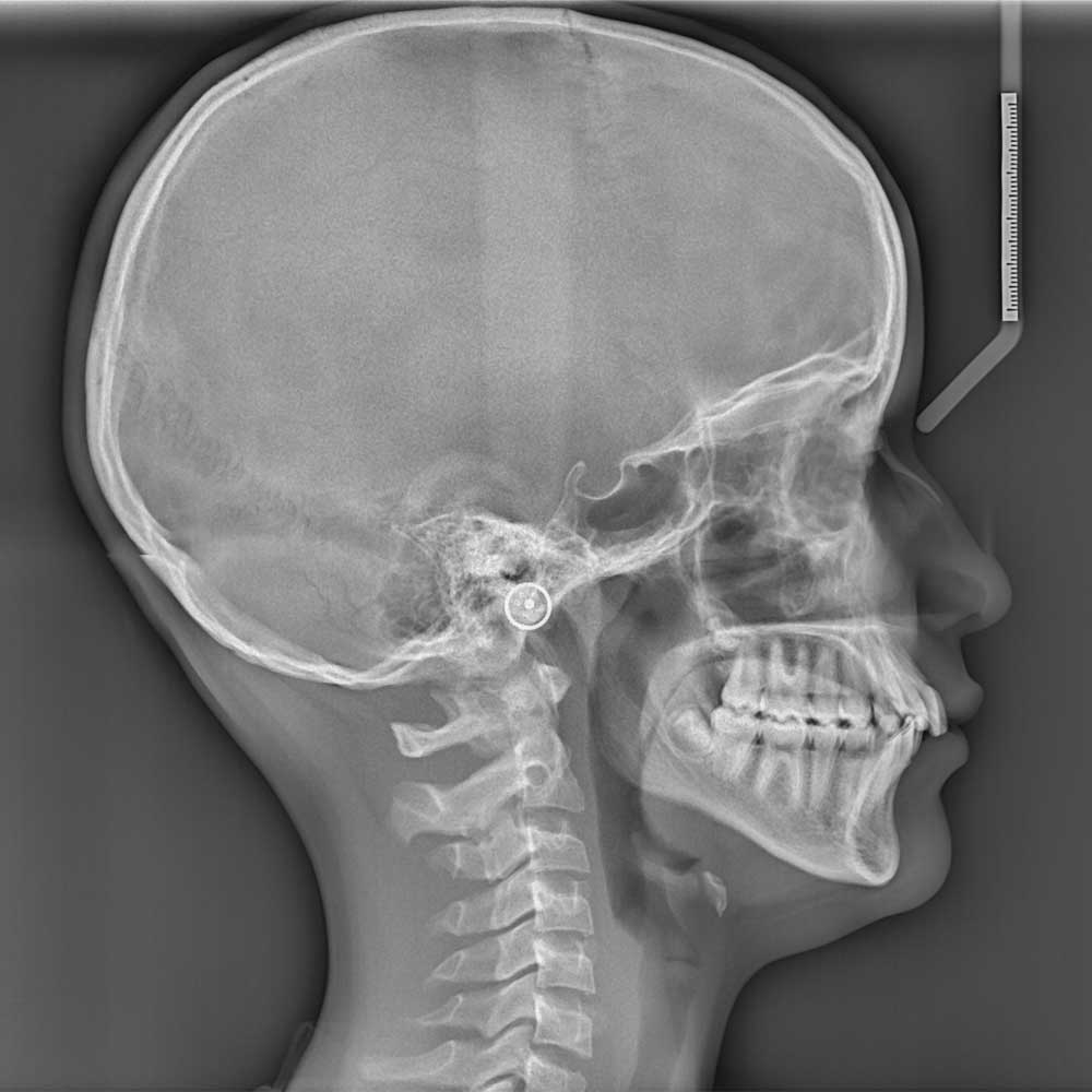 Kefalogram, rendgenska slika glave i vrata iz profila